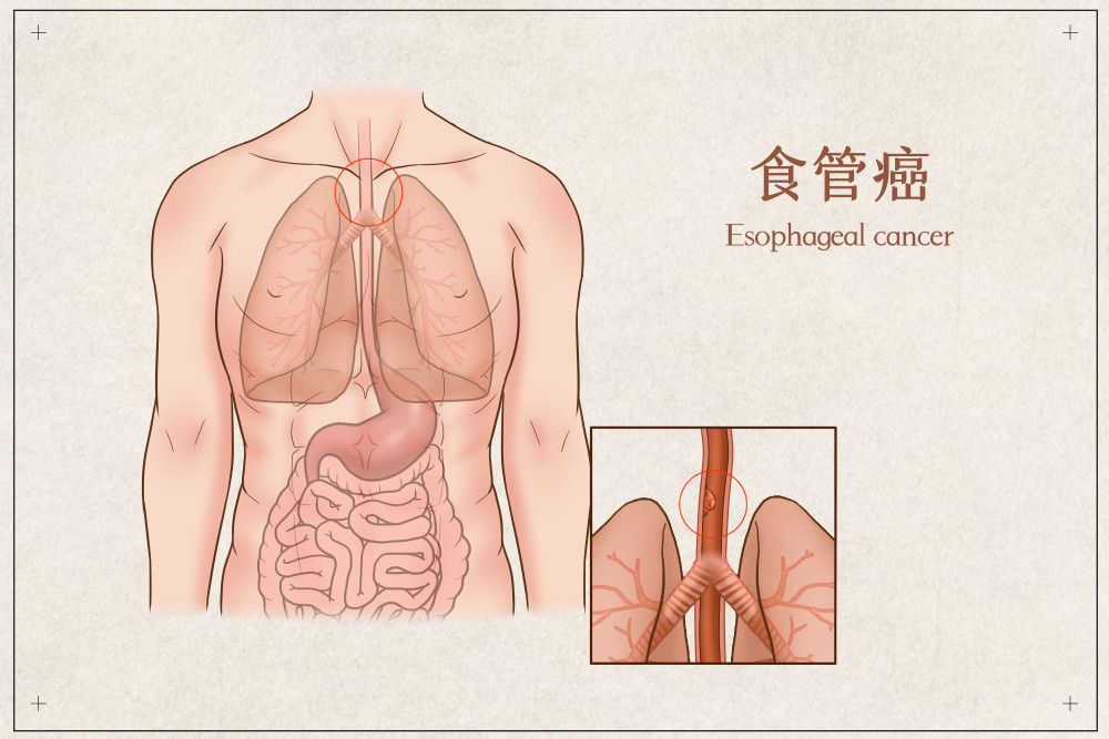 食管癌最新研究及治疗进展概述