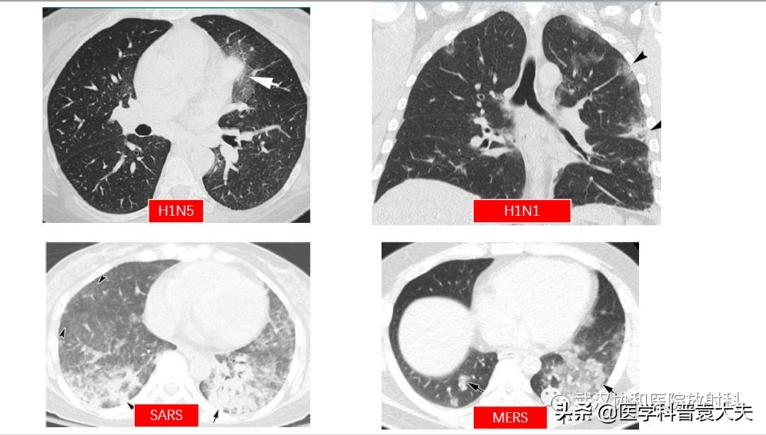 新兴冠状肺炎最新动态及应对策略概述